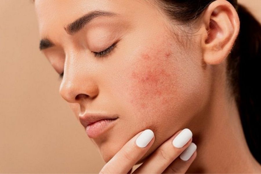Beda Dengan Jerawat Ketahui Semua Hal Tentang Rosacea Disini