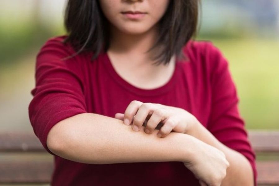 Cara Menghilangkan Bekas Gigitan Nyamuk