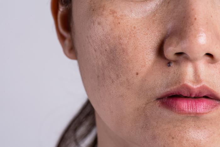 Dark Spot Membandel? Saatnya Kenali Gut-Skin Axis, Mikrobioma Kulit & Solusi dengan Scogel!