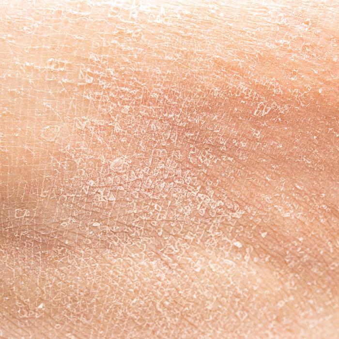 dry skin