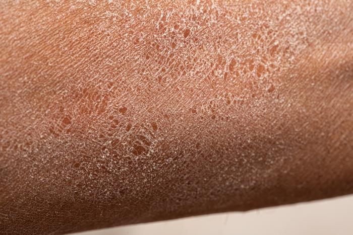 dry skin