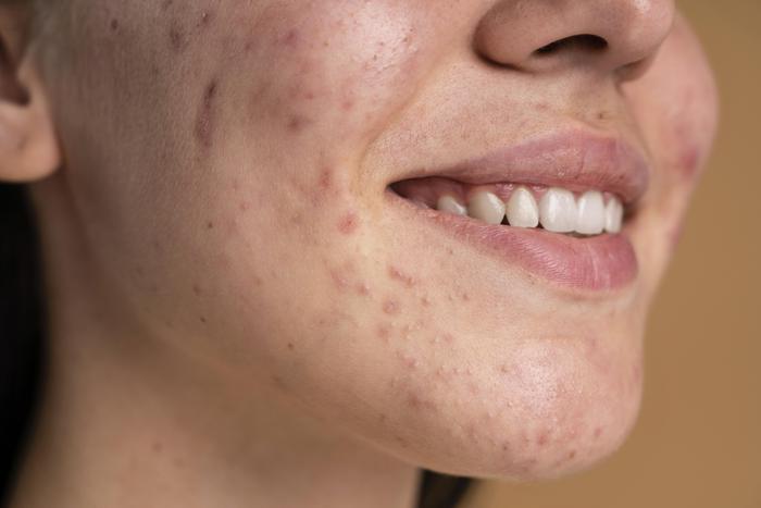 Udah rajin skincarean tapi masih jerawatan? Masalahnya bisa jadi bukan cuma di kulitmu! 