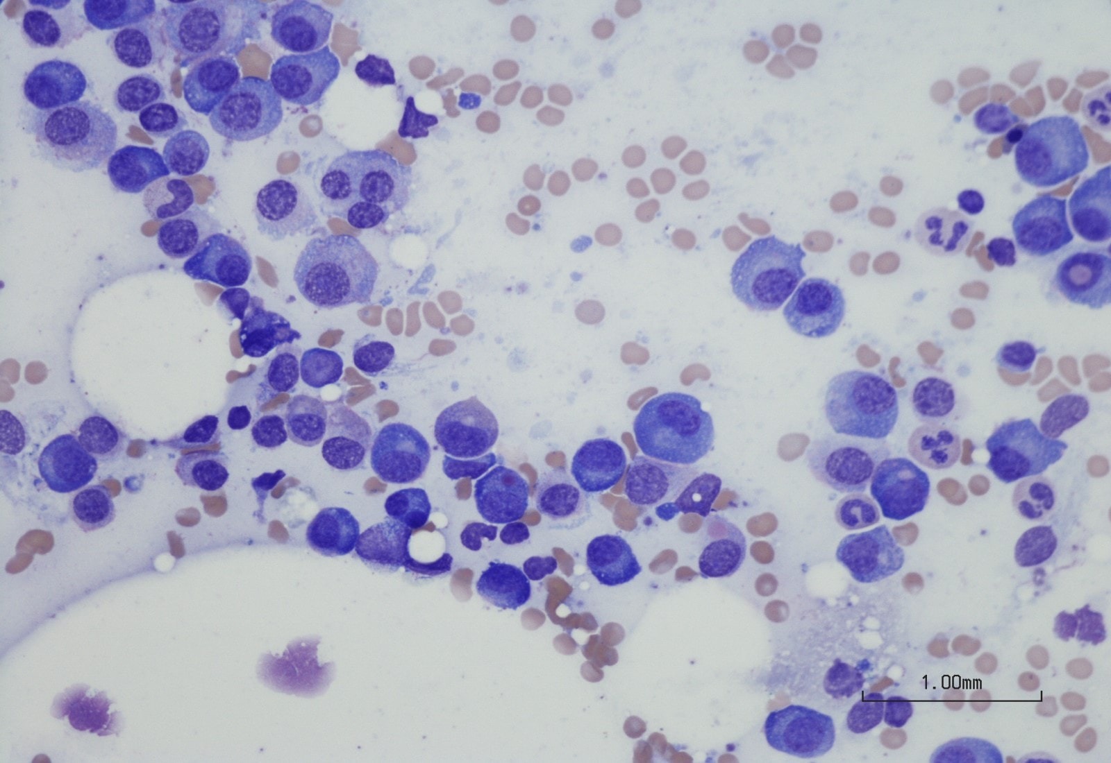 Apa Itu Myeloma? Kenali Penyebab dan Gejalanya