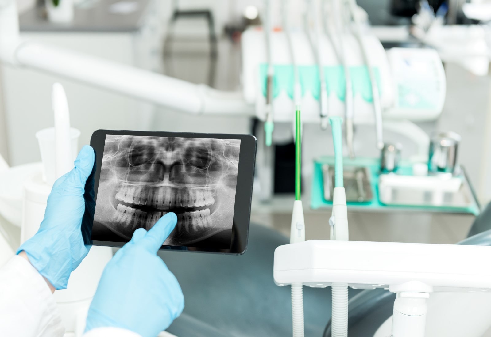 Cone Beam Computed Tomography (CBCT) untuk Implan Gigi yang Lebih Nyaman 
