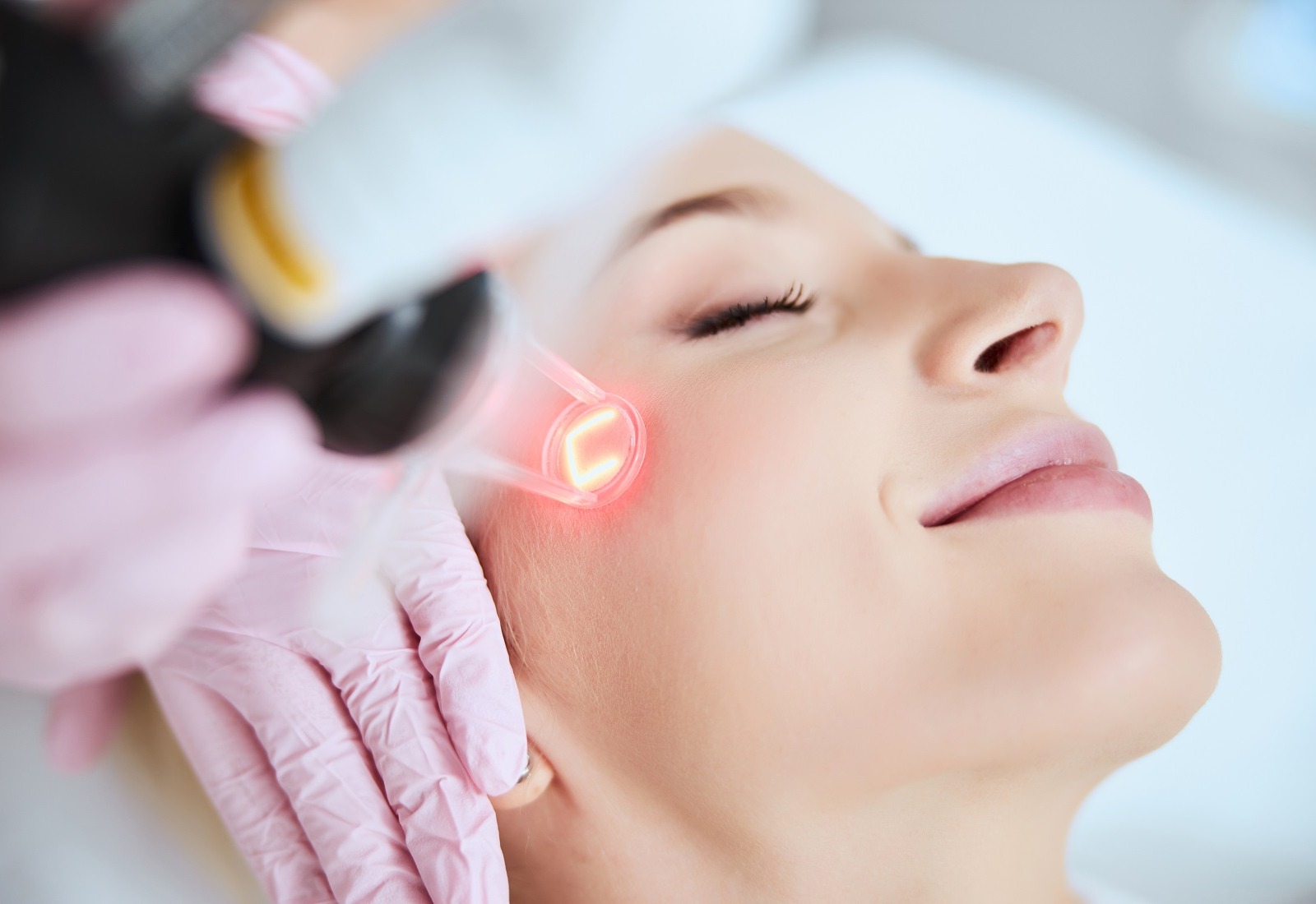 Teknologi Laser Kulit sebagai Solusi Efektif untuk Berbagai Masalah Kulit