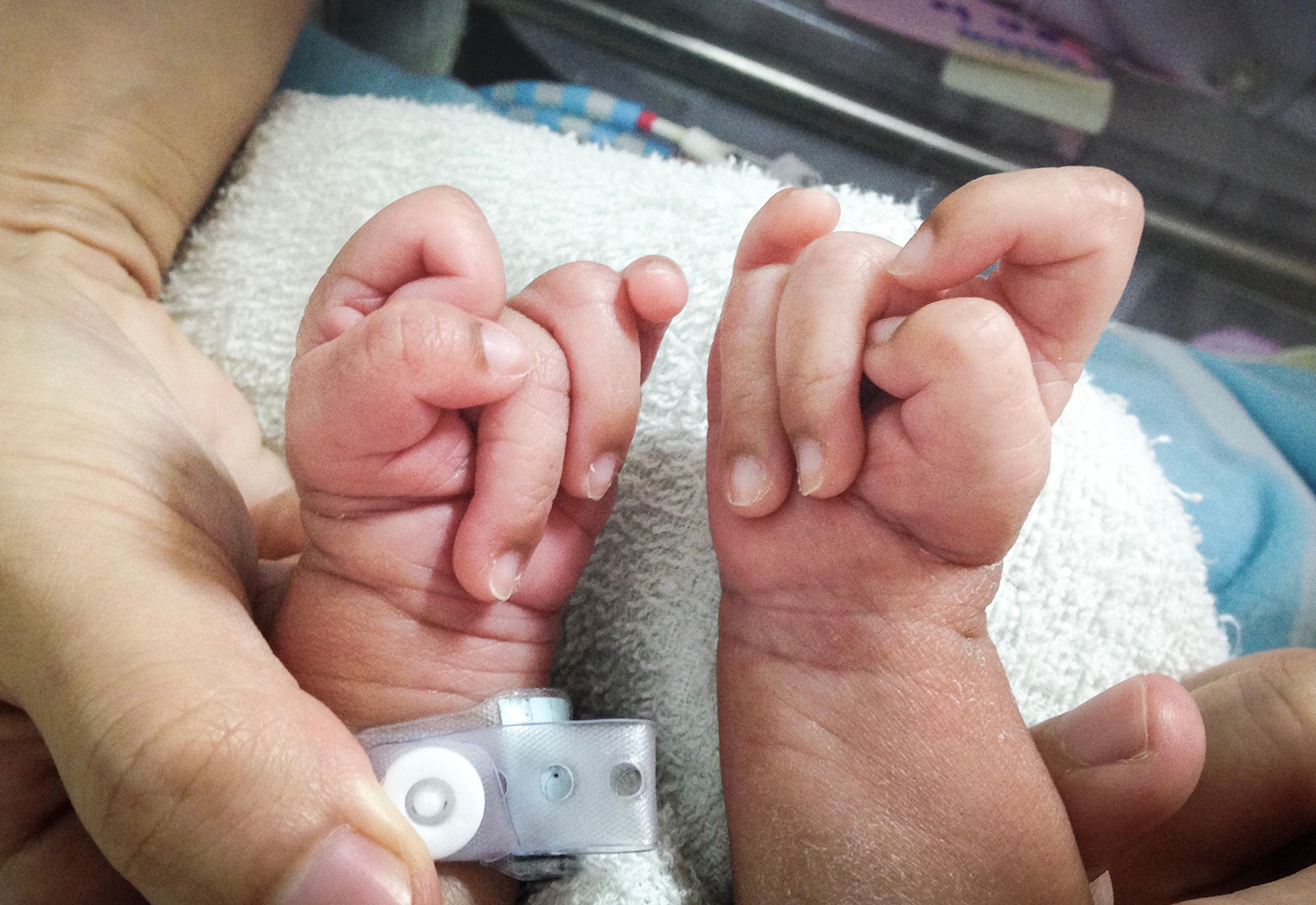 Sindrom Edward (Trisomi 18), Kelainan Genetik Langka yang Memengaruhi Perkembangan Bayi