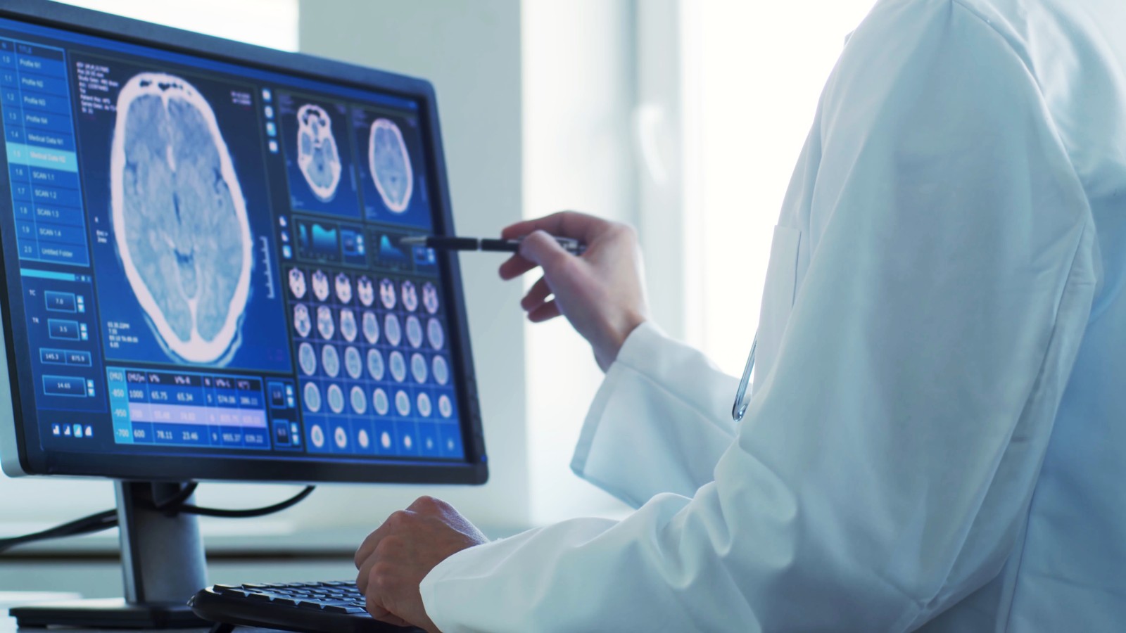 Penerapan Code Stroke, Sistem Penanganan Komprehensif untuk Stroke Akut
