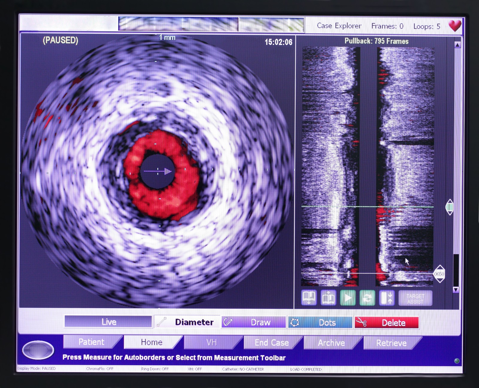 Teknologi IVUS dan Orbital Atherectomy