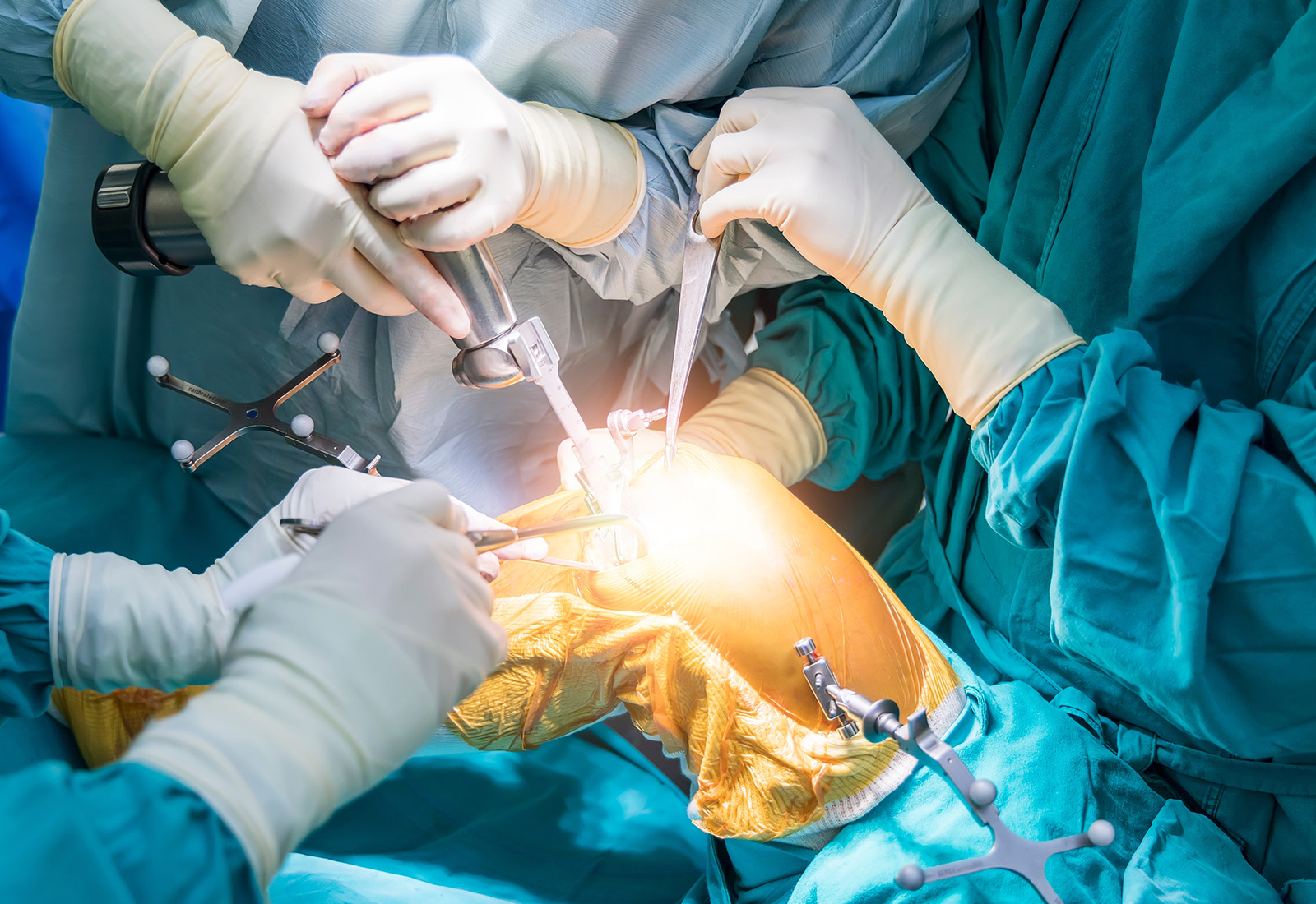 Mengenal Total Knee Replacement, Operasi Ganti Sendi Lutut yang Aman Dilakukan