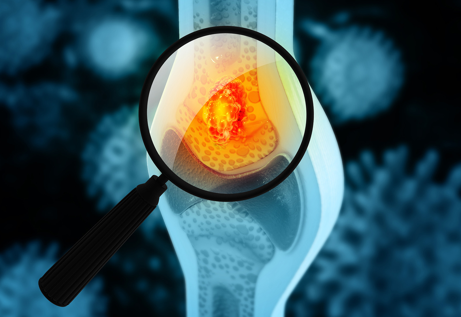 Sering Dikira Nyeri Biasa, Ini Seputar Kanker Tulang yang Perlu Dipahami