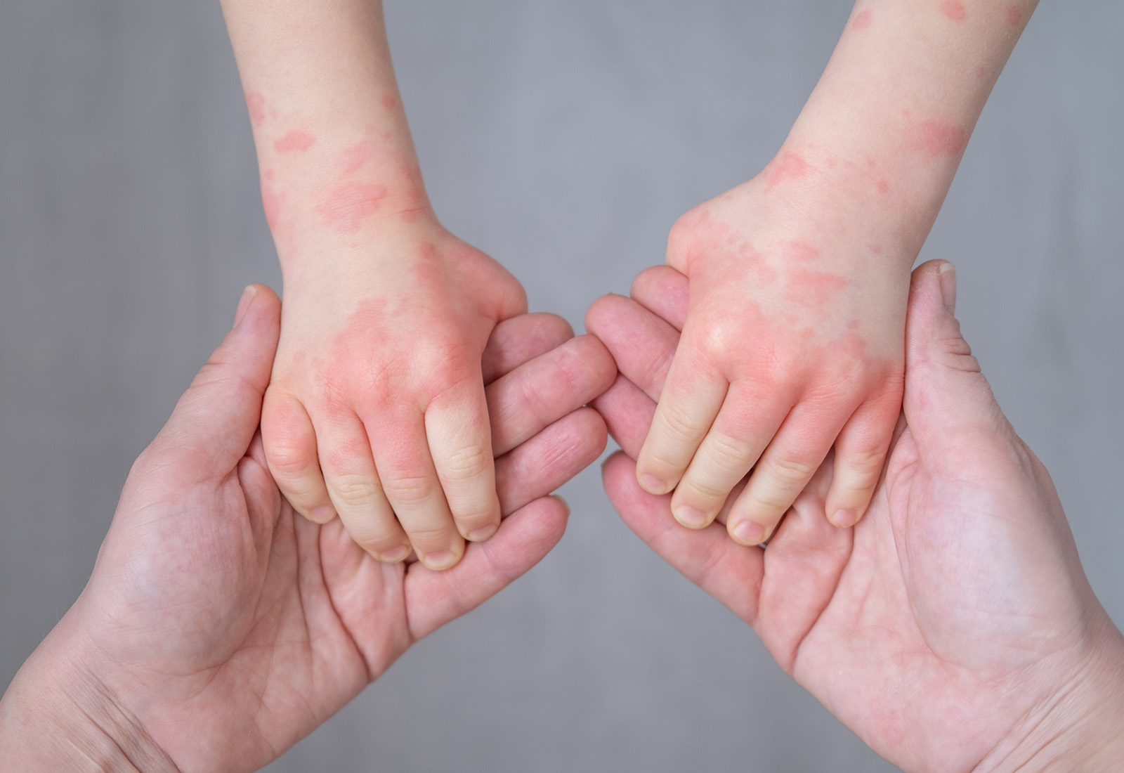 Alergi Makanan pada Bayi, Ini Informasi yang Perlu Diketahui oleh Orang Tua