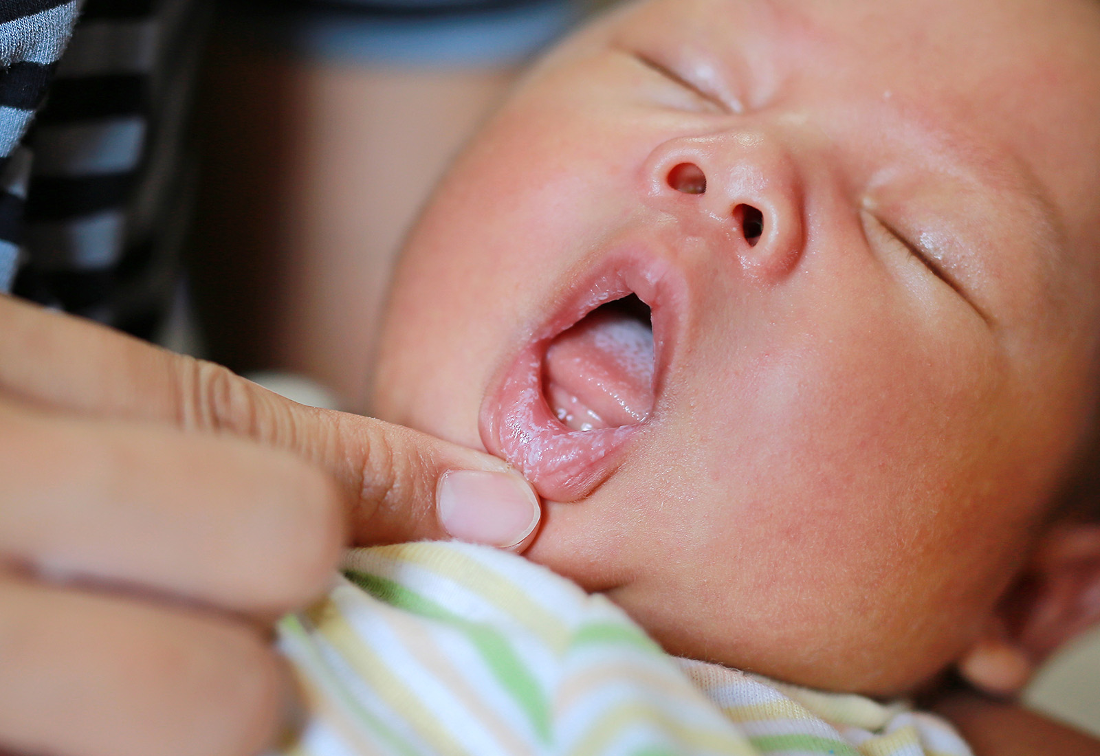 Waspadai Jamur di Mulut Bayi dan Ketahui Cara Mengobatinya