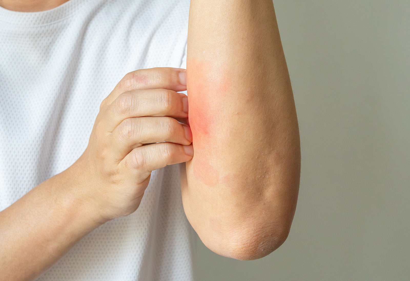 Dermatitis Atopik, Kenali Lebih Jauh Gejala, Penyebab, dan Pengobatannya 