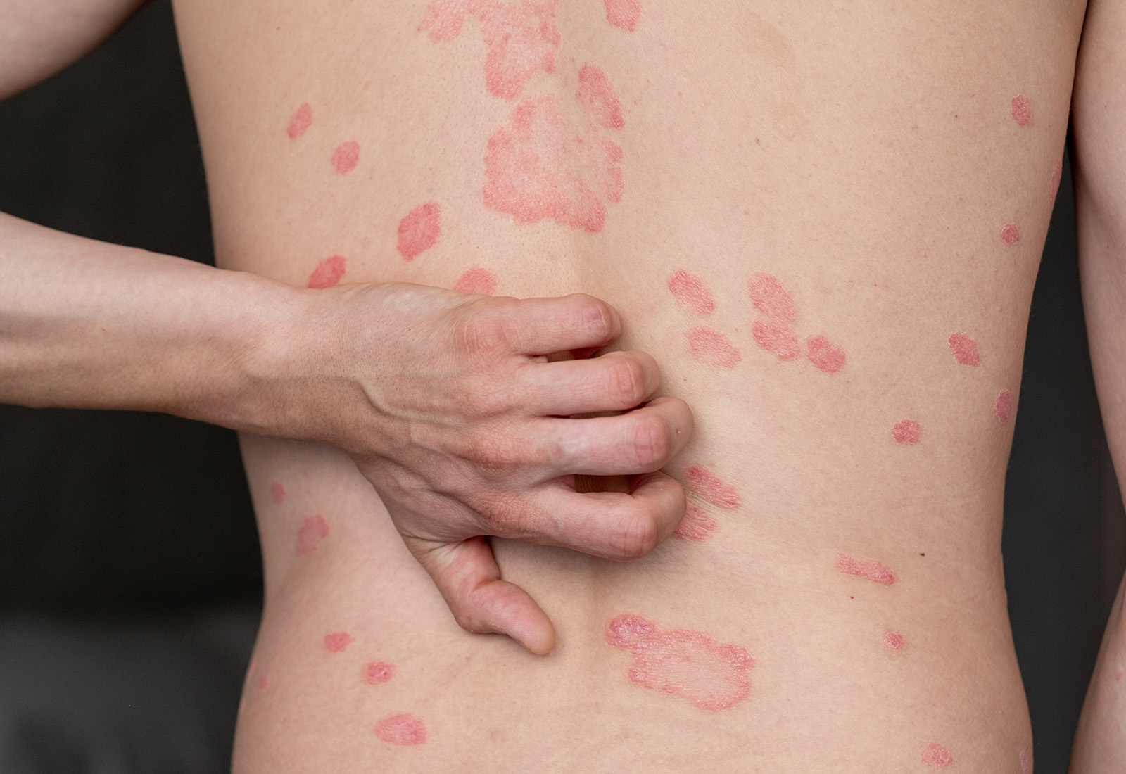 Psoriasis Vulgaris, Kenali Gejala, Penyebab, dan Pengobatannya