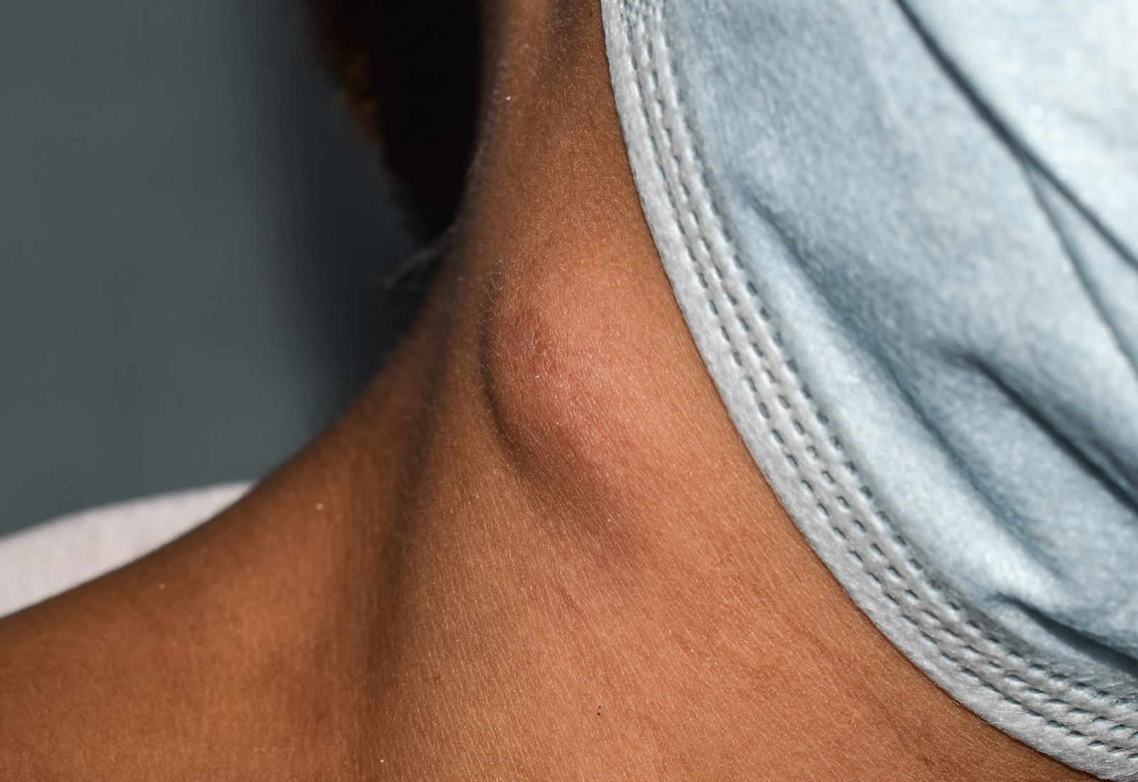 Periksa Benjolan di Leher ke Dokter Apa?