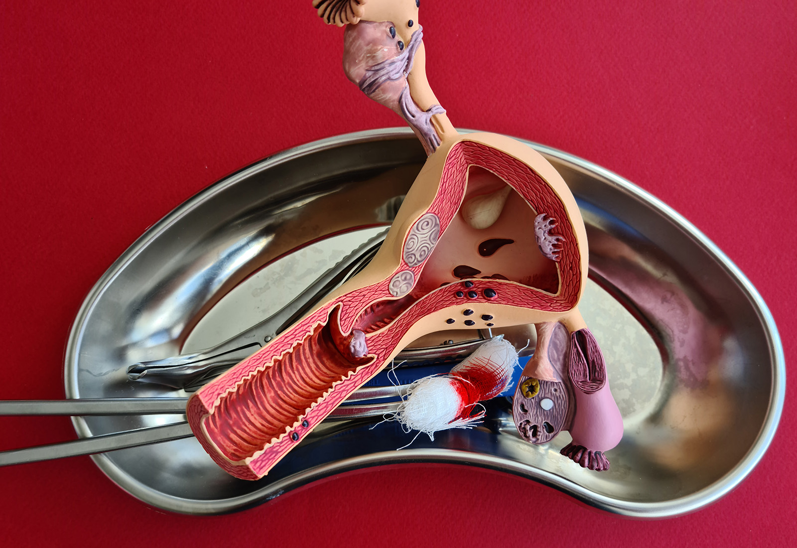 Pahami Operasi Angkat Rahim Sebelum Menjalani Prosedurnya