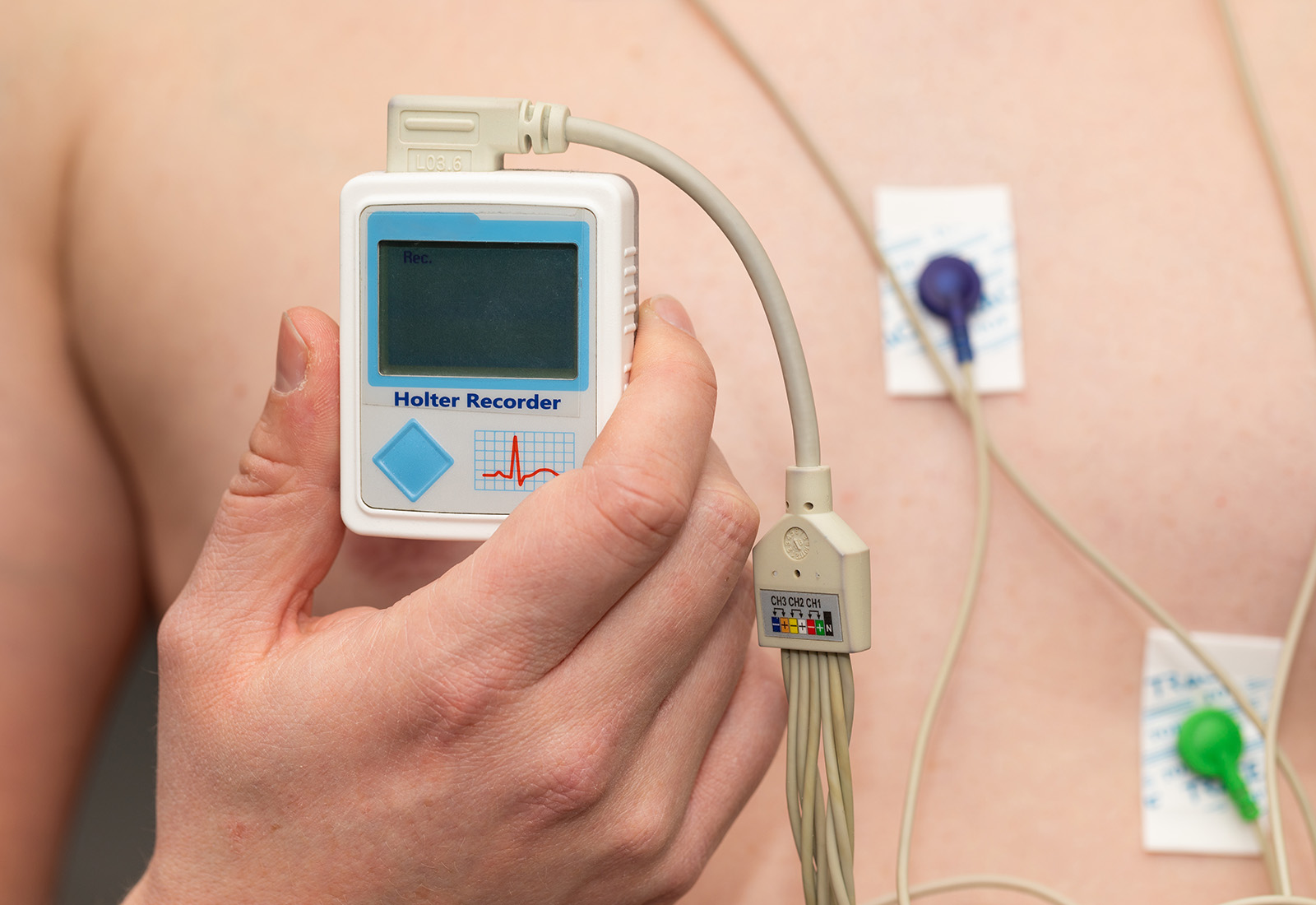 Holter Jantung di Jakarta dengan RS Pondok Indah untuk Rekam Jantung yang Praktis dan Akurat 