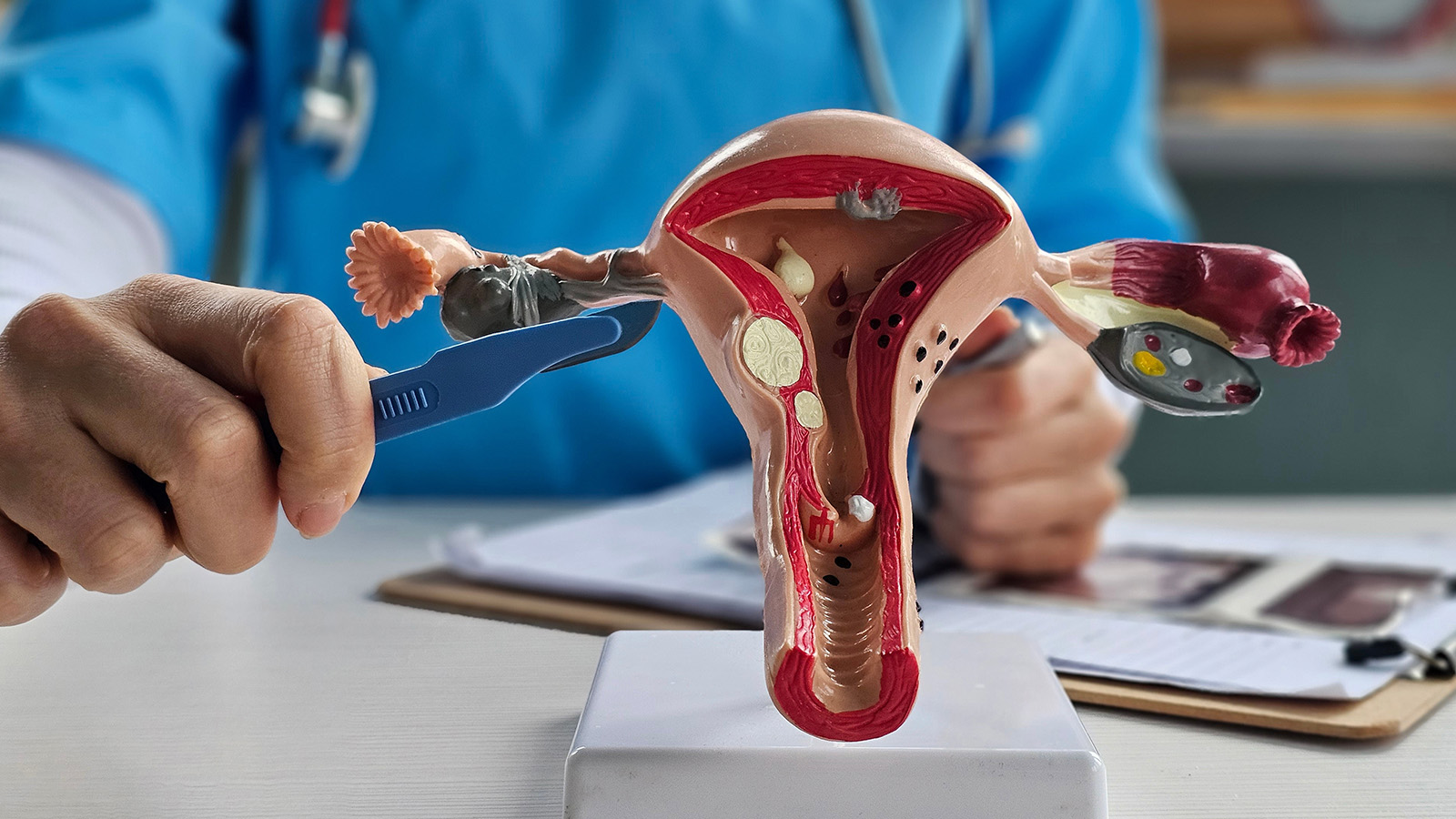 Pengobatan Miom dengan Prosedur Bedah Robotik