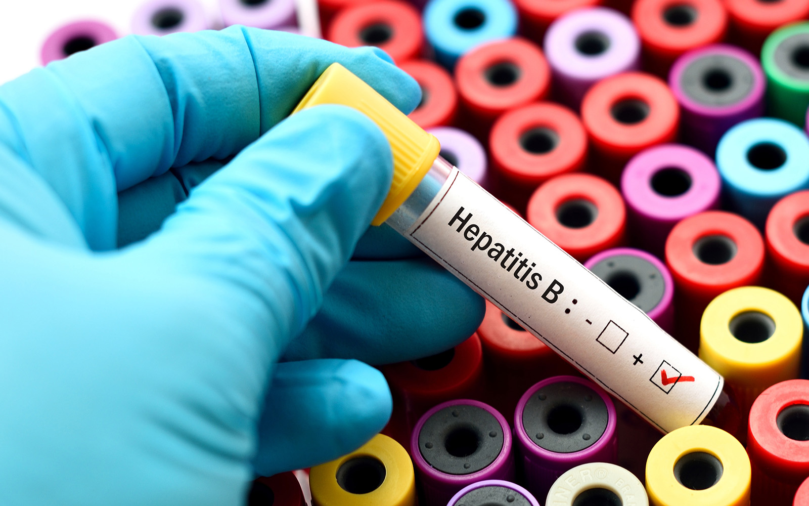 Kenali Hepatitis B, sebelum Kondisi ini Merusak Hati