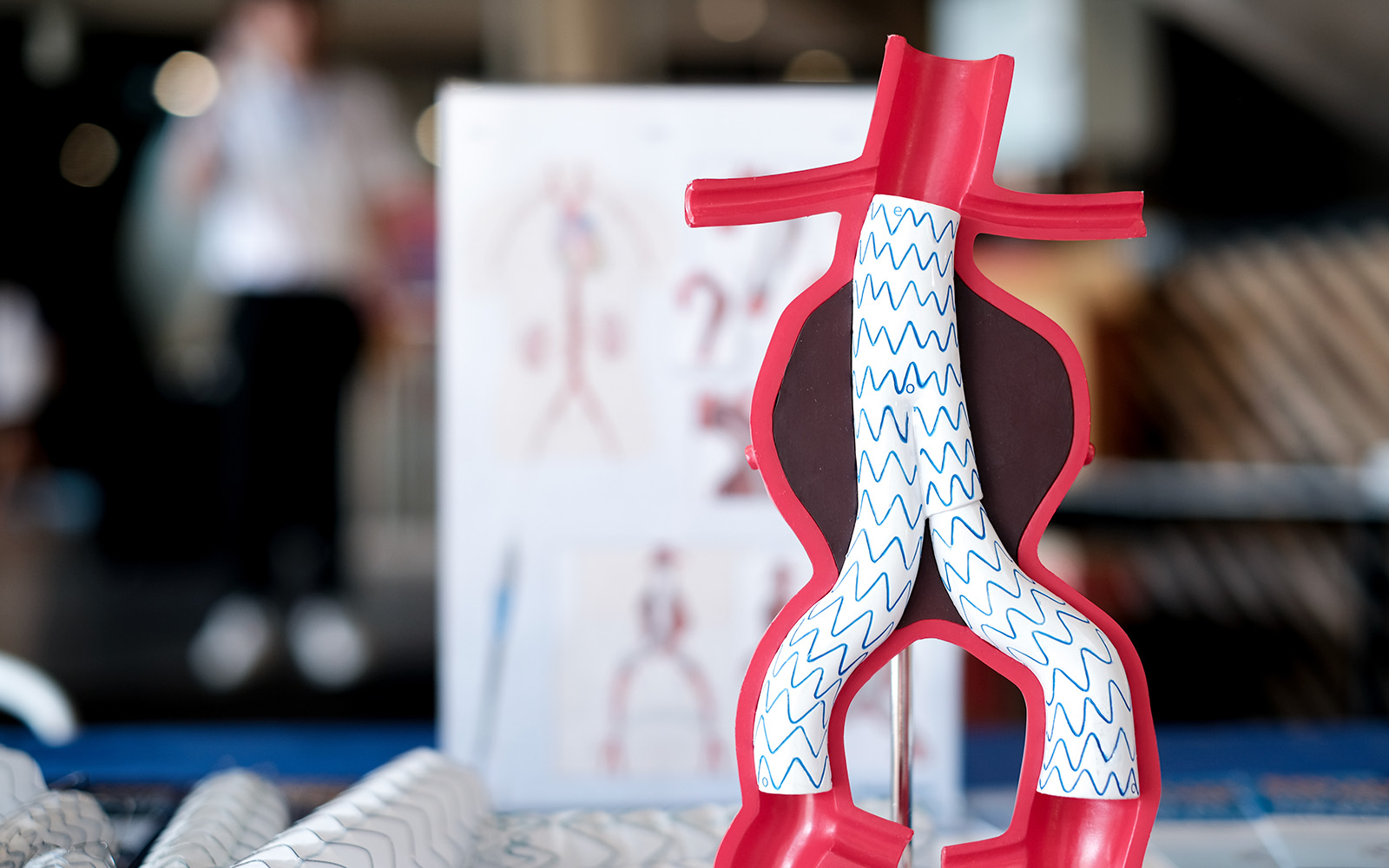 Mengenal Aneurisma Aorta sebelum Terjadi Komplikasi