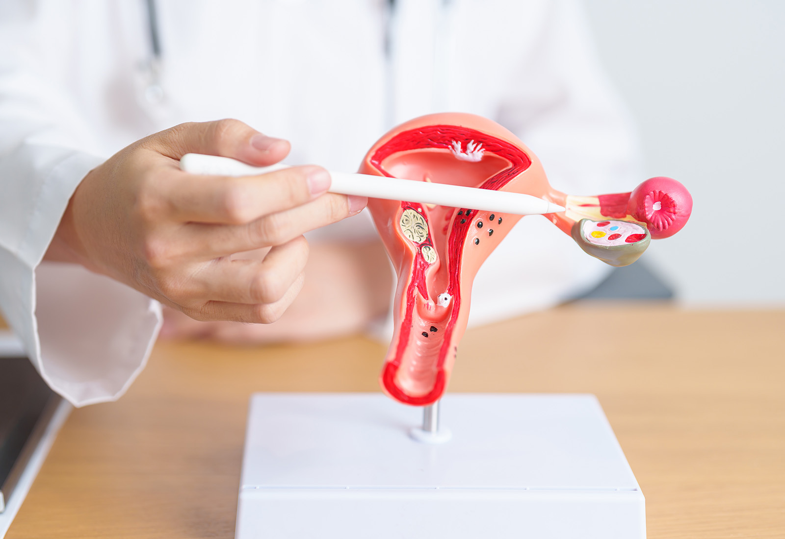 Apakah Kanker Ovarium Bisa Sembuh? Simak Opsi Penanganan Kanker Ovarium 