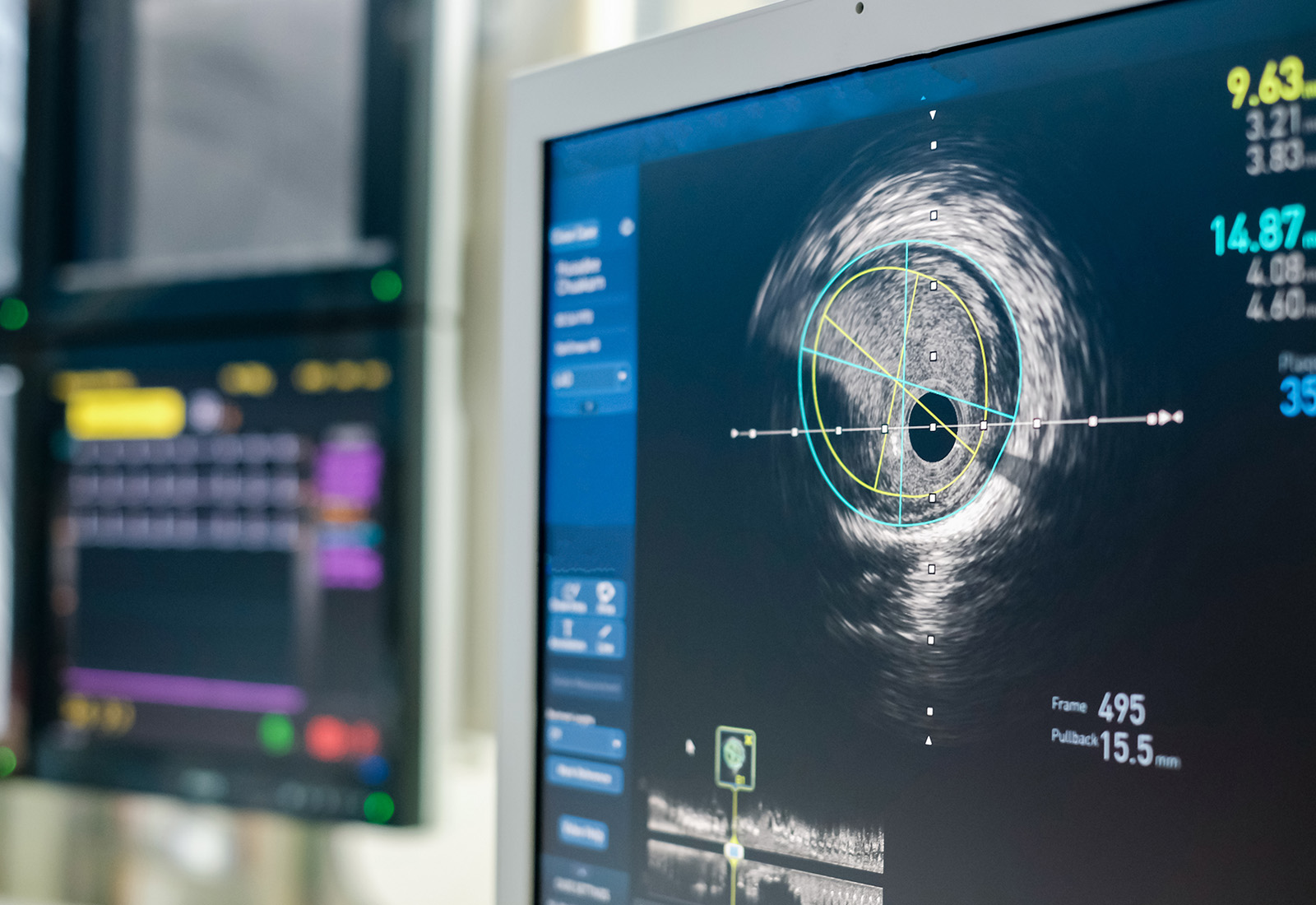 Apa itu Ultrasound Intravascular (IVUS)?