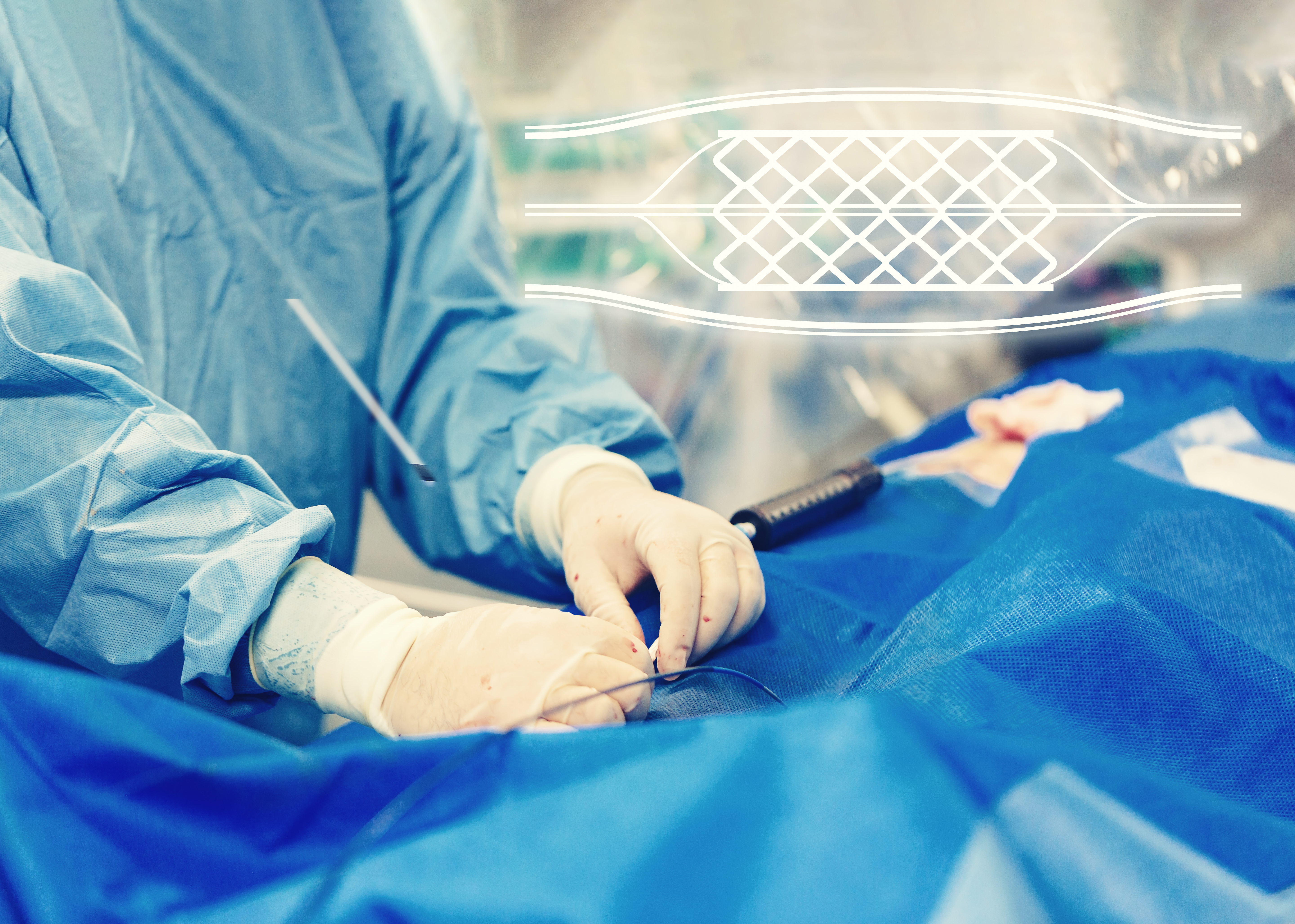 Understanding Heart Bypass Surgery for Coronary Artery Disease