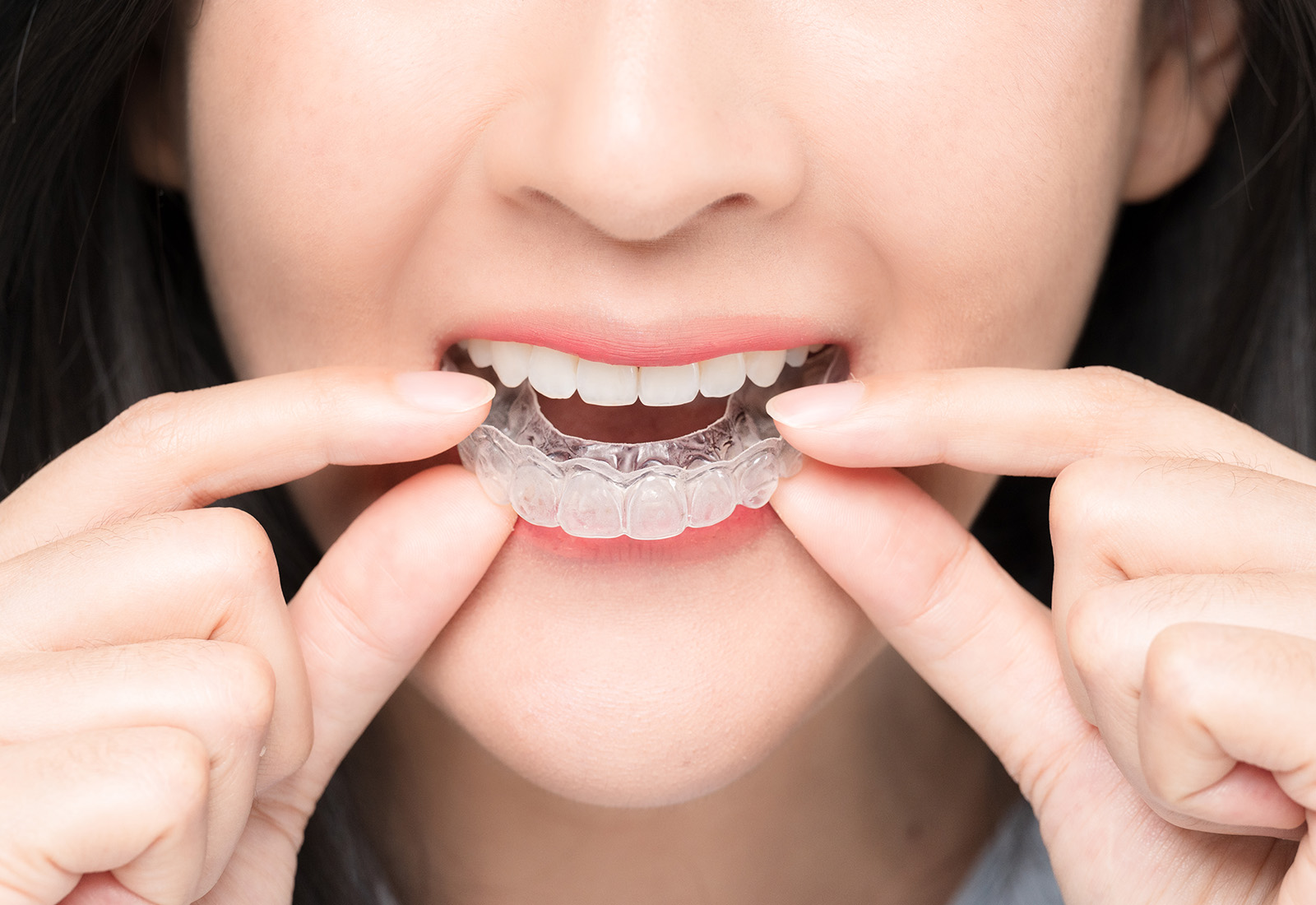 Invisalign, Gigi Rapi Tanpa Repot