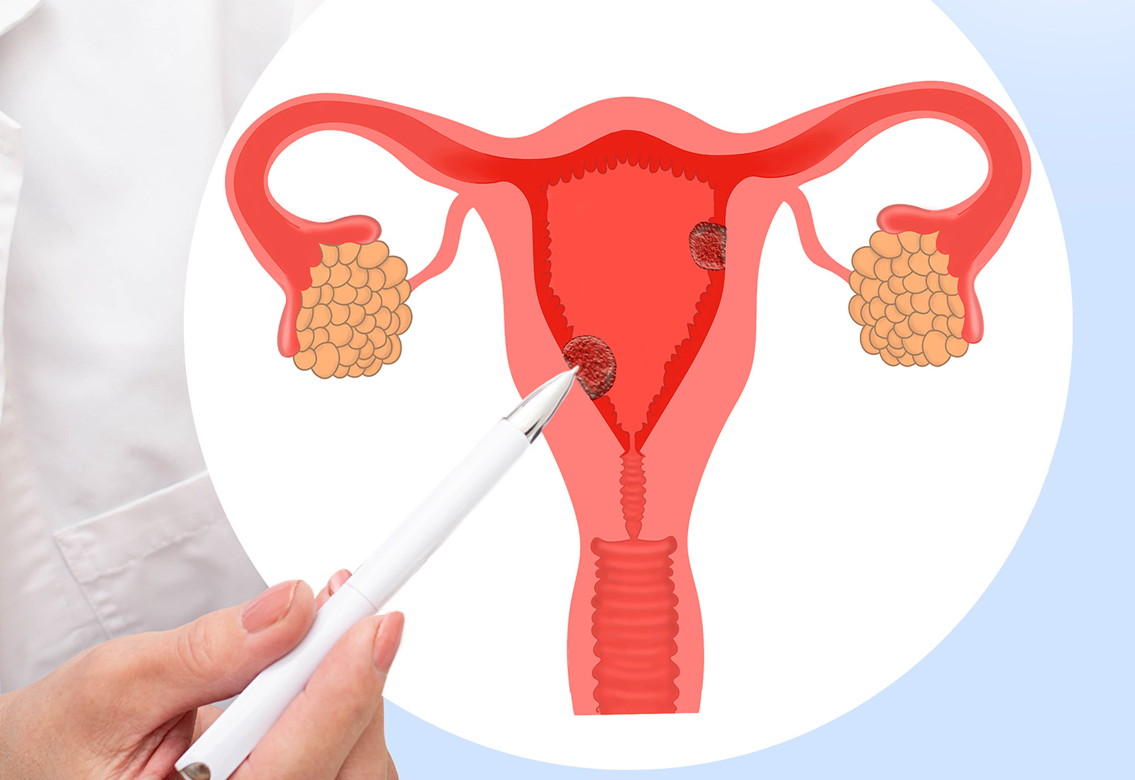 Ketahui Kanker Rahim, Penyebab, Gejala, dan Cara Pengobatannya