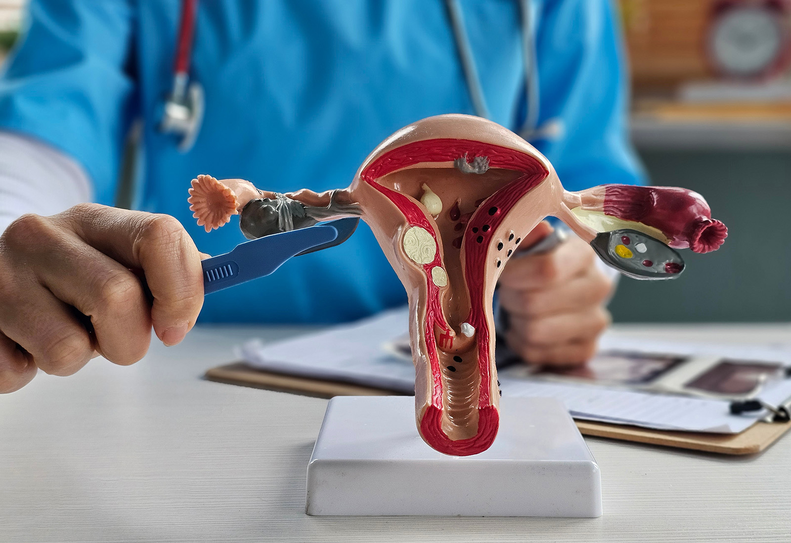 Mengenal Operasi Miom, dari Indikasi Hingga Manfaatnya