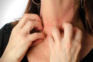 Alergi: Menyelami Dalam Gejala, Penyebab, dan Penanganan